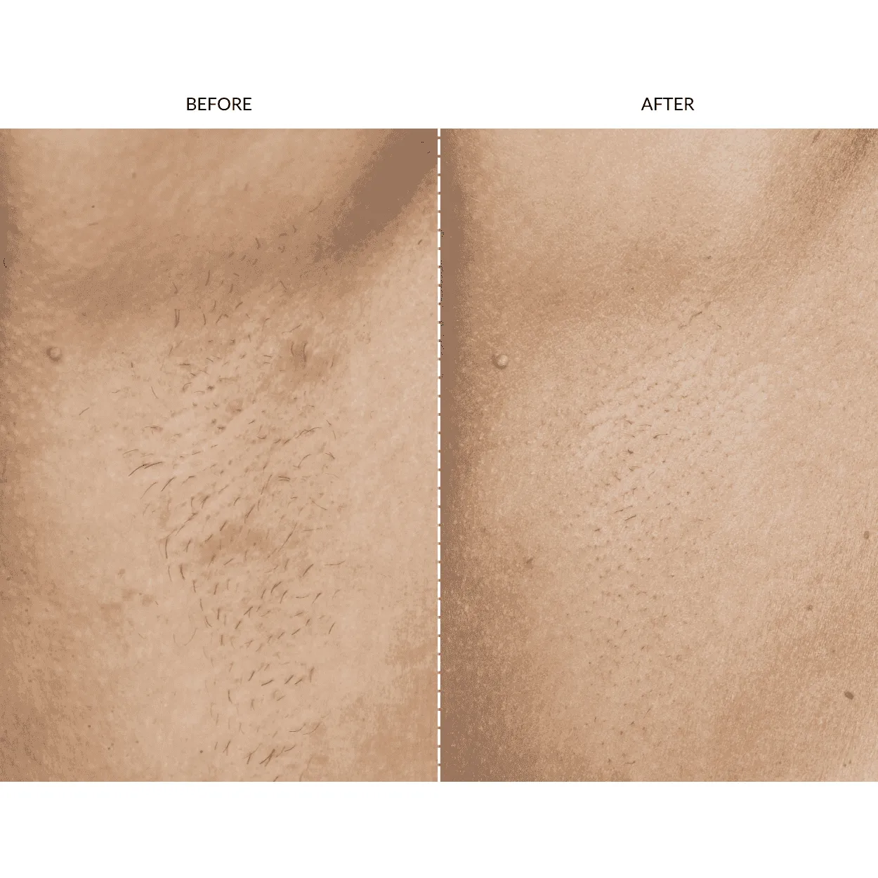 TikTok Shop SmoothSkin Pure Fit IPL Device